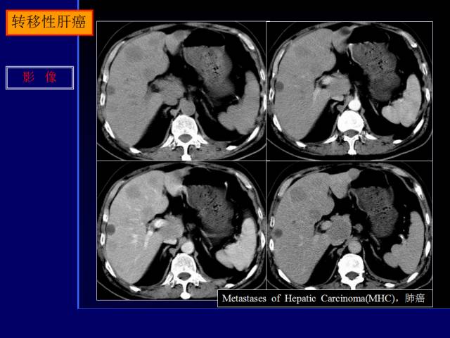 【PPT】常见肝胆胰腺疾病的CT(全)