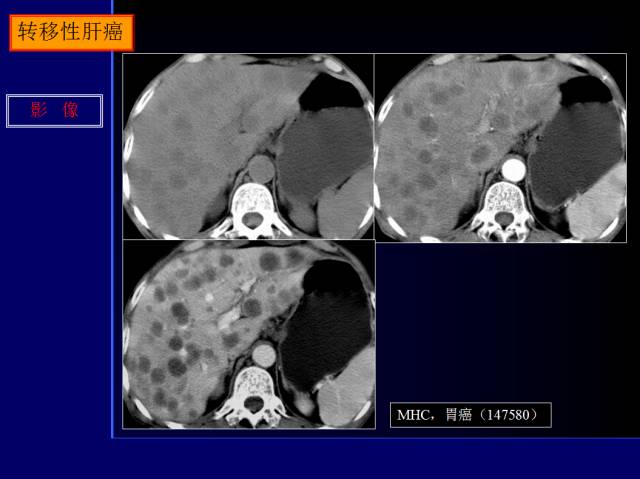 【PPT】常见肝胆胰腺疾病的CT(全)