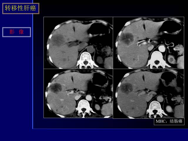 【PPT】常见肝胆胰腺疾病的CT(全)