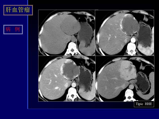 【PPT】常见肝胆胰腺疾病的CT(全)
