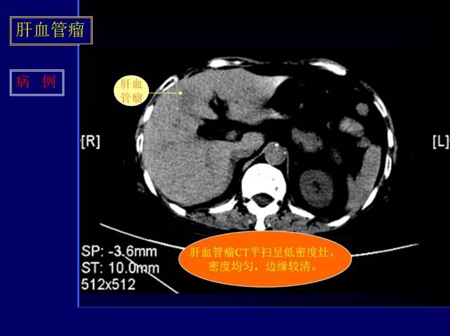【PPT】常见肝胆胰腺疾病的CT(全)
