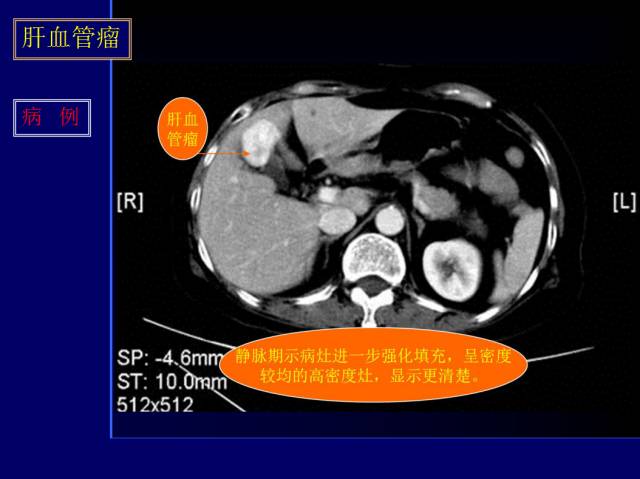 【PPT】常见肝胆胰腺疾病的CT(全)