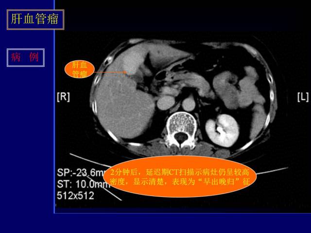 【PPT】常见肝胆胰腺疾病的CT(全)