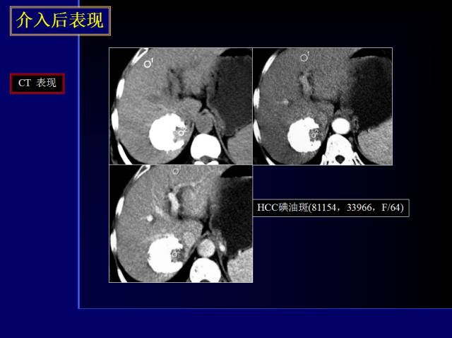 【PPT】常见肝胆胰腺疾病的CT(全)