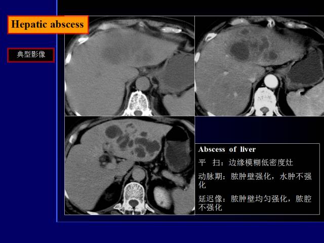 【PPT】常见肝胆胰腺疾病的CT(全)