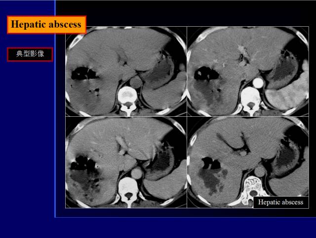 【PPT】常见肝胆胰腺疾病的CT(全)