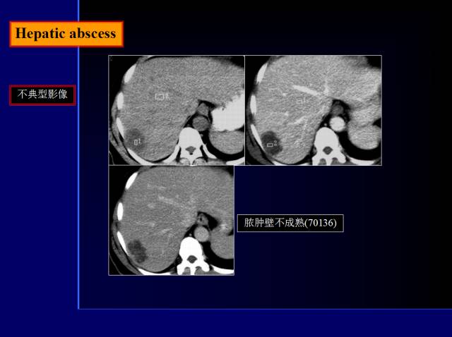 【PPT】常见肝胆胰腺疾病的CT(全)