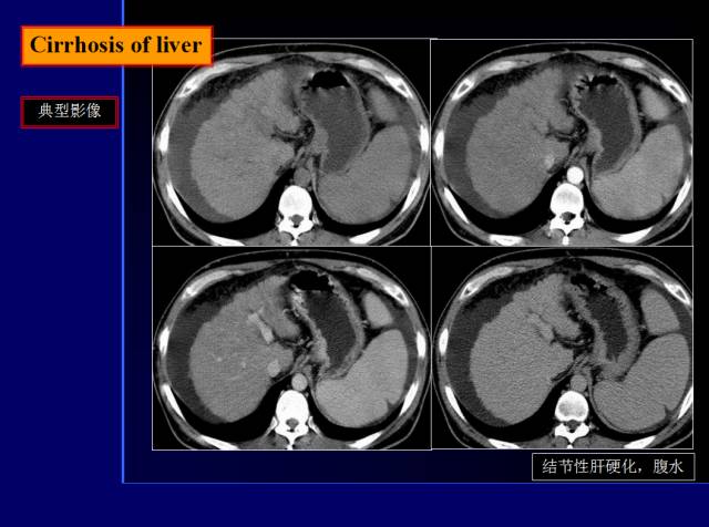 【PPT】常见肝胆胰腺疾病的CT(全)