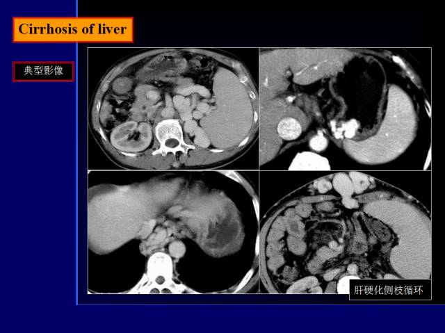 【PPT】常见肝胆胰腺疾病的CT(全)