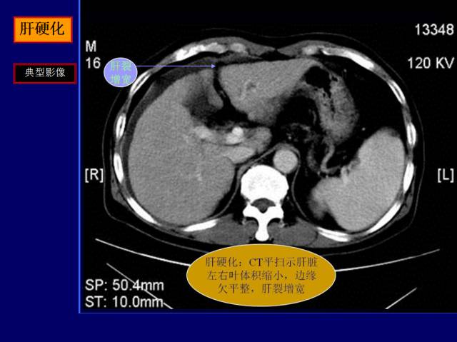 【PPT】常见肝胆胰腺疾病的CT(全)