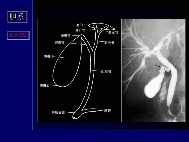 【PPT】常见肝胆胰腺疾病的CT(全)