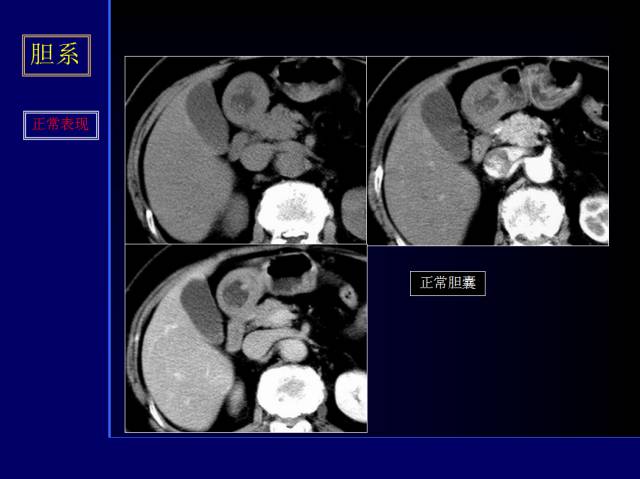 【PPT】常见肝胆胰腺疾病的CT(全)