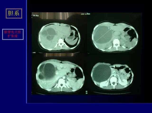 【PPT】常见肝胆胰腺疾病的CT(全)