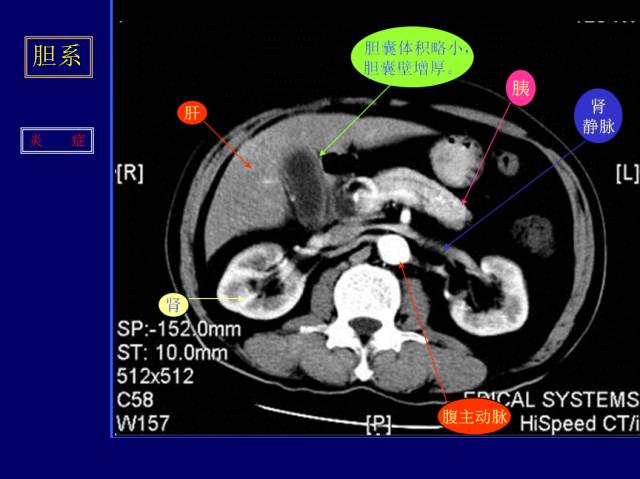 【PPT】常见肝胆胰腺疾病的CT(全)
