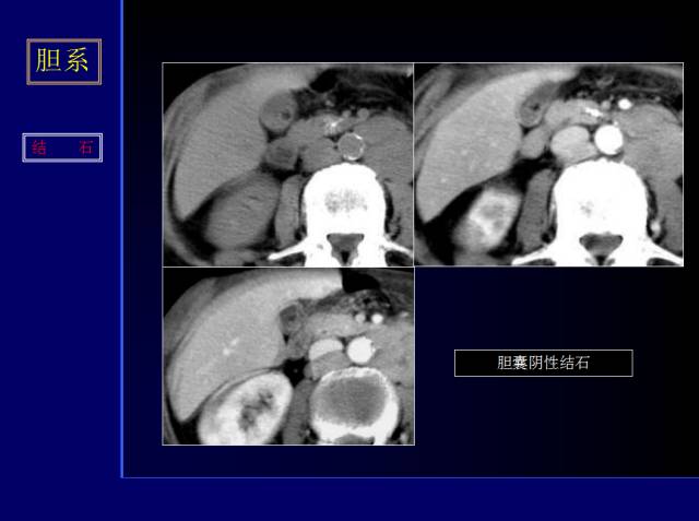 【PPT】常见肝胆胰腺疾病的CT(全)