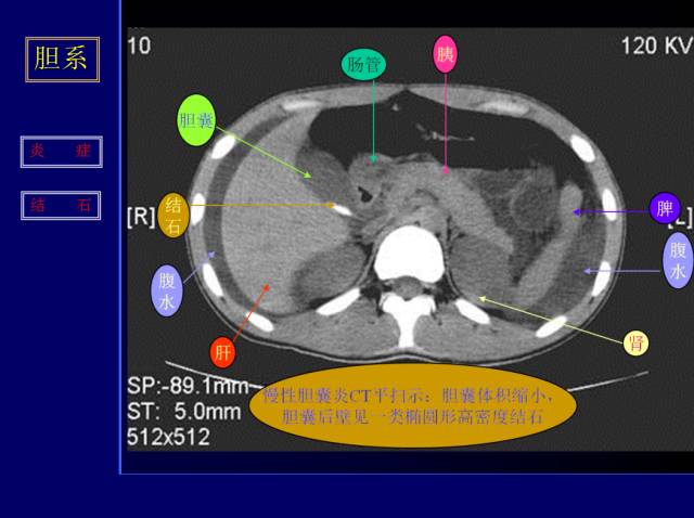 【PPT】常见肝胆胰腺疾病的CT(全)