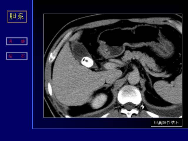 【PPT】常见肝胆胰腺疾病的CT(全)