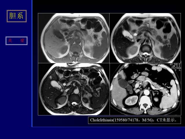 【PPT】常见肝胆胰腺疾病的CT(全)