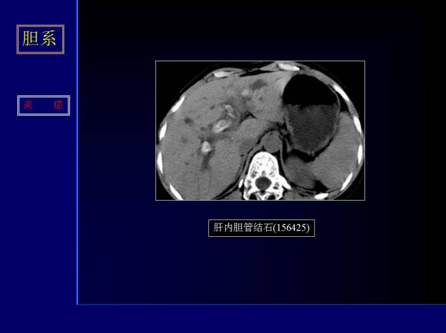 【PPT】常见肝胆胰腺疾病的CT(全)