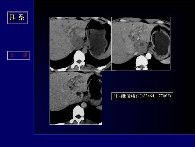 【PPT】常见肝胆胰腺疾病的CT(全)
