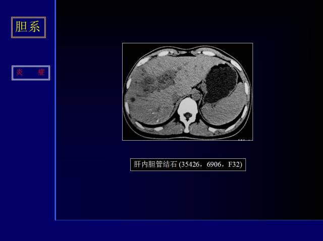 【PPT】常见肝胆胰腺疾病的CT(全)