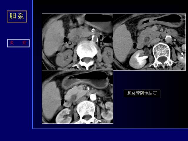 【PPT】常见肝胆胰腺疾病的CT(全)