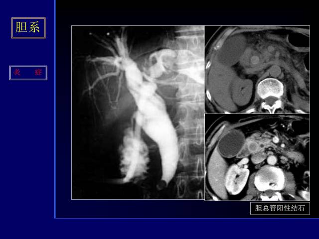【PPT】常见肝胆胰腺疾病的CT(全)