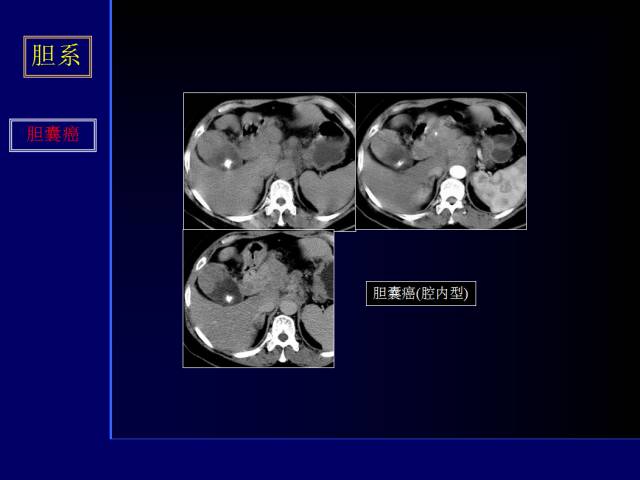 【PPT】常见肝胆胰腺疾病的CT(全)