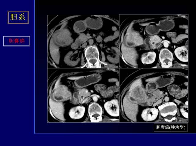 【PPT】常见肝胆胰腺疾病的CT(全)
