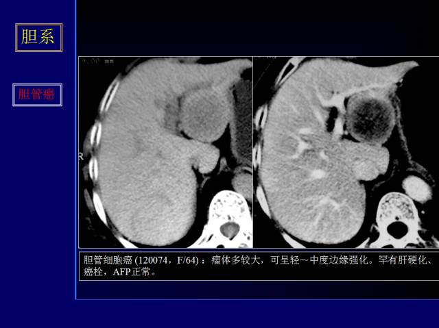 【PPT】常见肝胆胰腺疾病的CT(全)