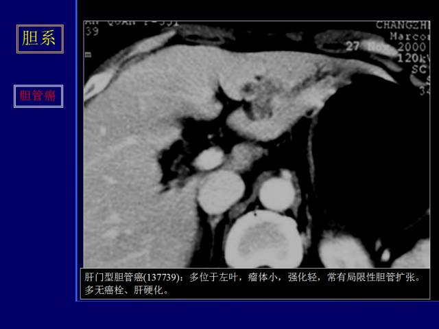 【PPT】常见肝胆胰腺疾病的CT(全)