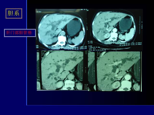 【PPT】常见肝胆胰腺疾病的CT(全)