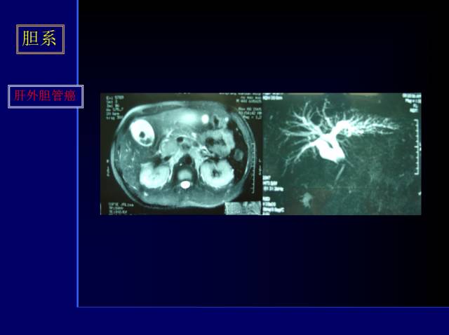 【PPT】常见肝胆胰腺疾病的CT(全)