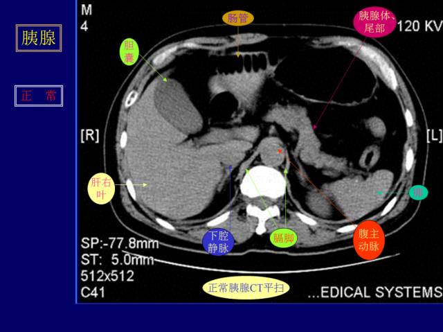 【PPT】常见肝胆胰腺疾病的CT(全)