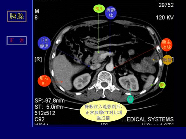【PPT】常见肝胆胰腺疾病的CT(全)