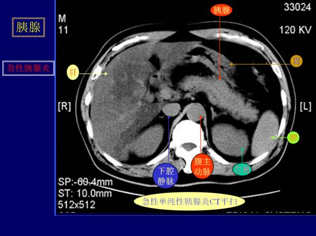 【PPT】常见肝胆胰腺疾病的CT(全)