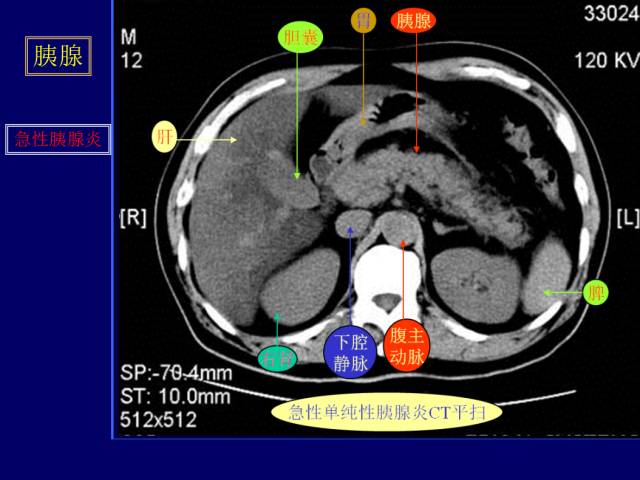 【PPT】常见肝胆胰腺疾病的CT(全)