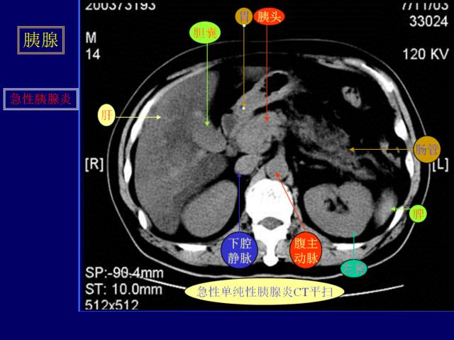 【PPT】常见肝胆胰腺疾病的CT(全)