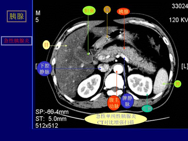 【PPT】常见肝胆胰腺疾病的CT(全)