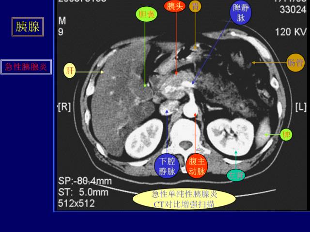 【PPT】常见肝胆胰腺疾病的CT(全)