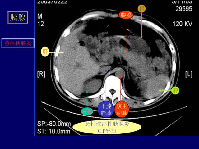 【PPT】常见肝胆胰腺疾病的CT(全)