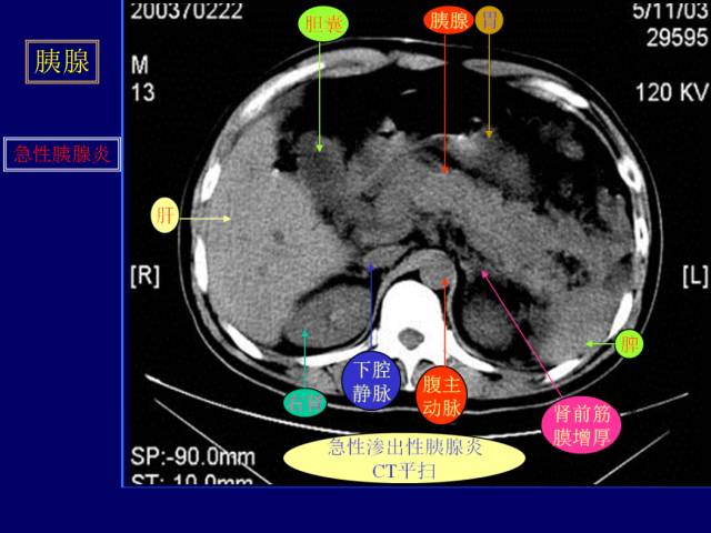 【PPT】常见肝胆胰腺疾病的CT(全)