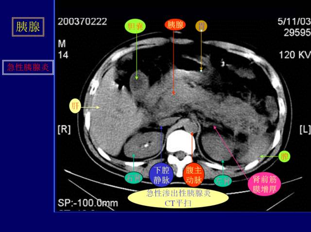 【PPT】常见肝胆胰腺疾病的CT(全)