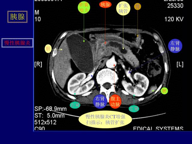 【PPT】常见肝胆胰腺疾病的CT(全)