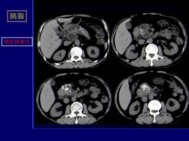 【PPT】常见肝胆胰腺疾病的CT(全)
