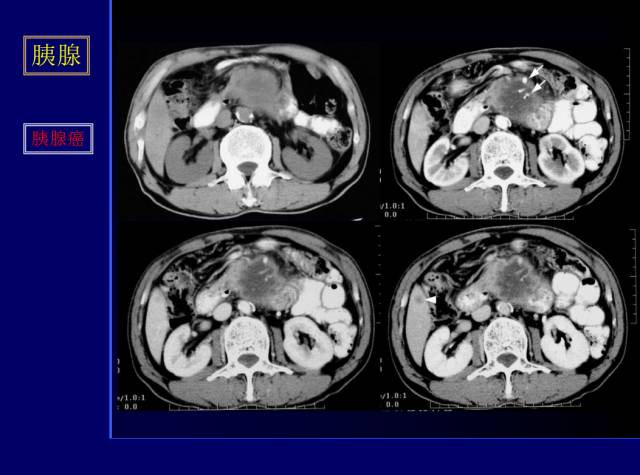 【PPT】常见肝胆胰腺疾病的CT(全)