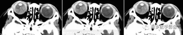 【病例】视网膜母细胞瘤1例CT影像表现