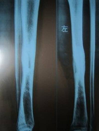 骨关节影像学征象—— 骨关节影像学征象——