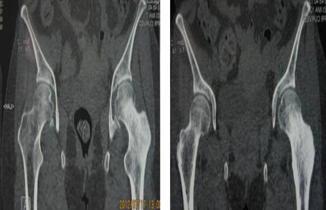 骨关节影像学征象—— 骨关节影像学征象——