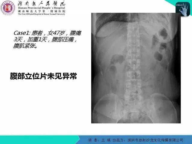 【PPT】急诊放射影像检查新变化——胸腹篇